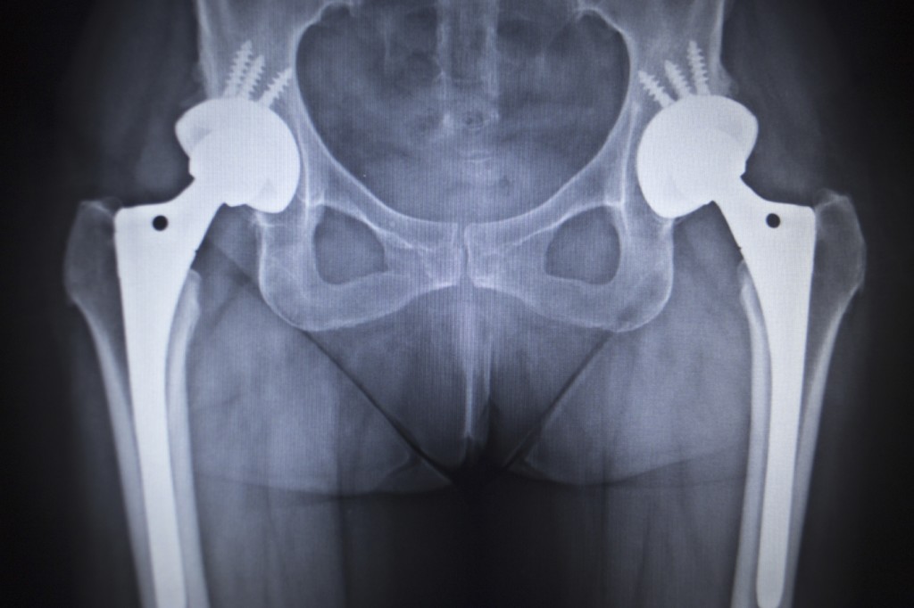 Hip Joint Replacement Surgery