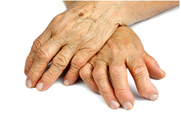 What Are The Signs & Symptoms of Rheumatoid Arthritis? Four Early Warning Signs to Look Out For