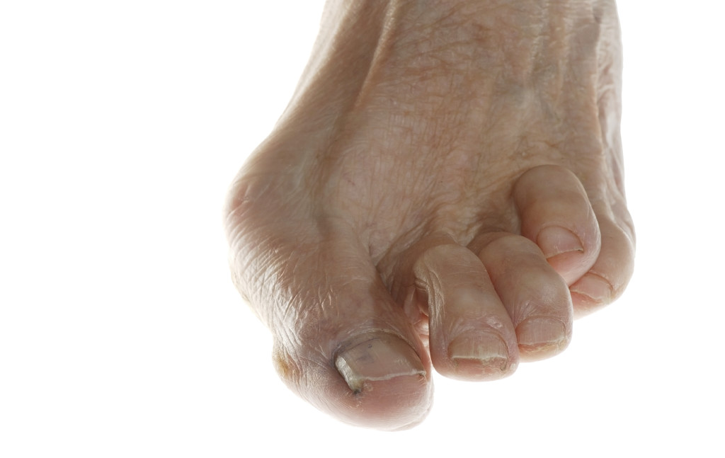 What to Know About Toe Deformities
